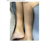 Scurvy case in New Zealand child